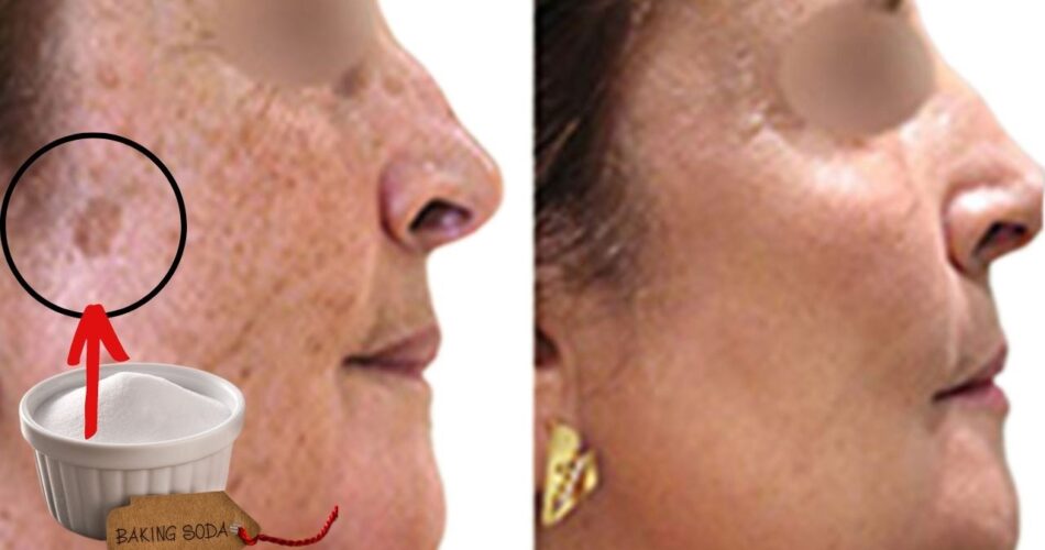 AMAZING! Baking Soda Erases Age Spots Like an Eraser