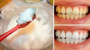The Quick At-Home Teeth Whitening Secret