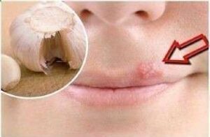 Garlic Gets Rid of Herpes Overnight