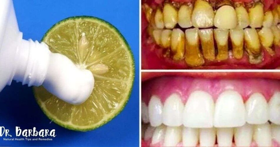 Brighten Your Smile Naturally The Two-Minute Lemon Whitening Method