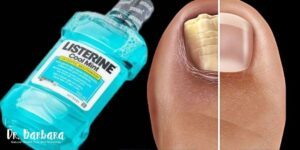 Say Goodbye to Nail Fungus with This Simple Home Remedy