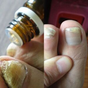 Discover the Miracle Solution Essential Oils for Toenail Fungus