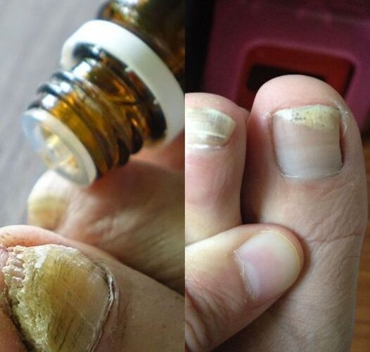 Discover the Miracle Solution Essential Oils for Toenail Fungus