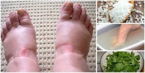 Home Remedies for Swollen Feet Simple and Effective Solutions