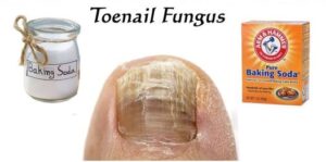 Say Goodbye to Toenail Fungus with This Natural Remedy