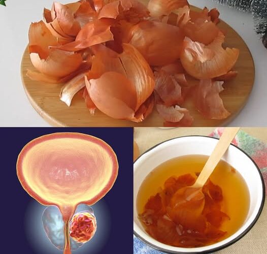 Bladder and Prostate Like New! Grandpa’s Old Onion Peel Remedy!