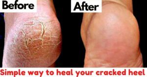 How To Heal Your Cracked Feet With These 6 Home Remedies