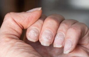 Problems With the Adrenal Glands Can Affect the Health of Your Hair, and Nails and Cause Problems With Sleep