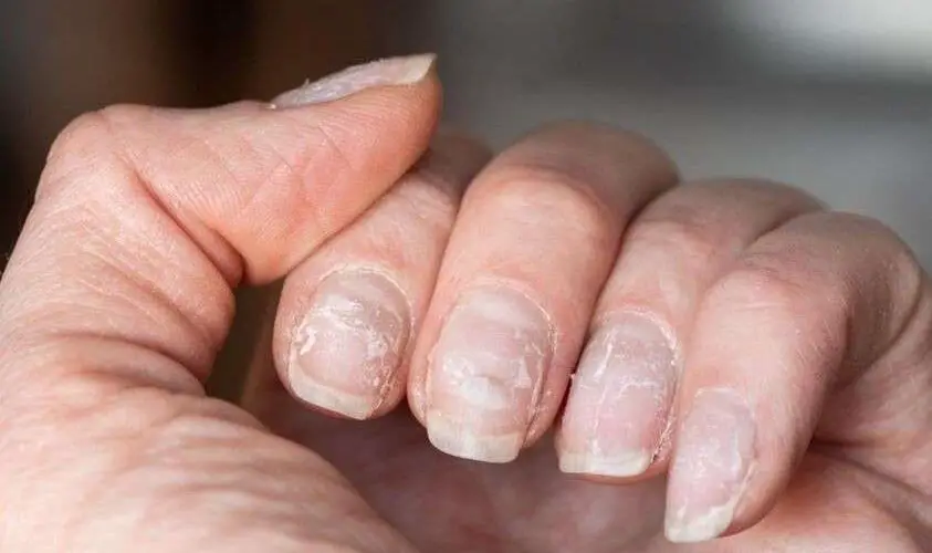 Problems With the Adrenal Glands Can Affect the Health of Your Hair, and Nails and Cause Problems With Sleep