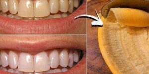 A Brighter Smile with a Simple Secret The Banana Peel Trick