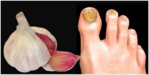 A Natural Remedy for Nail Fungus That Works Wonders
