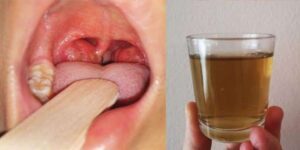 Vanquish Throat Pain and Inflammation in Just One Day with These Simple Recipes!