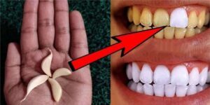 Unlock the Secret to a Brighter Smile with Garlic