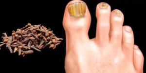 Removes Nail Fungus Instantly, Like an Eraser! The Best Remedy!