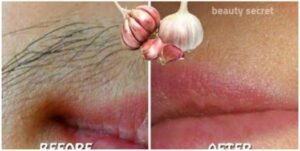 Say Goodbye to Unwanted Hair with Garlic