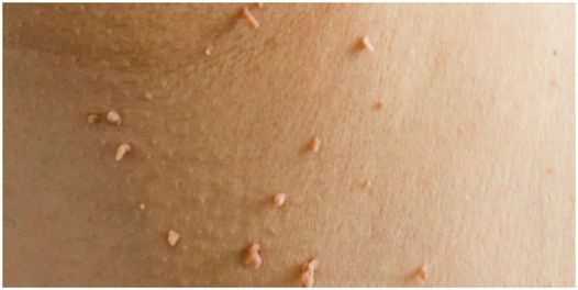 Easy Home Remedies for Skin Tags and Plantar Warts