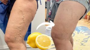 Lemon for Varicose Veins