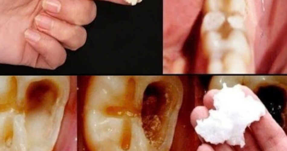How to Naturally Repair a Cavity and Strengthen Your Teeth